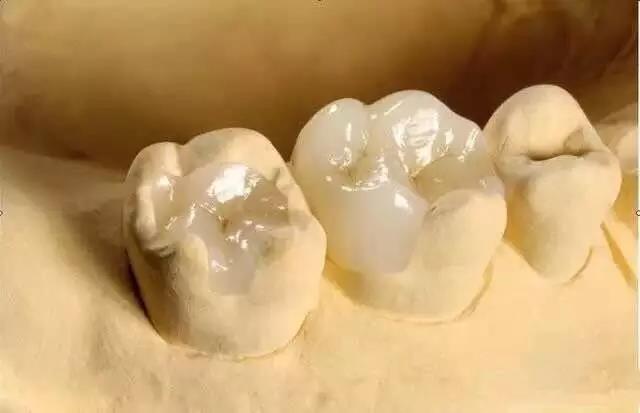 Trám răng Zirconia để khắc phục khiếm khuyết bề mặt nhỏ của răng tự nhiên