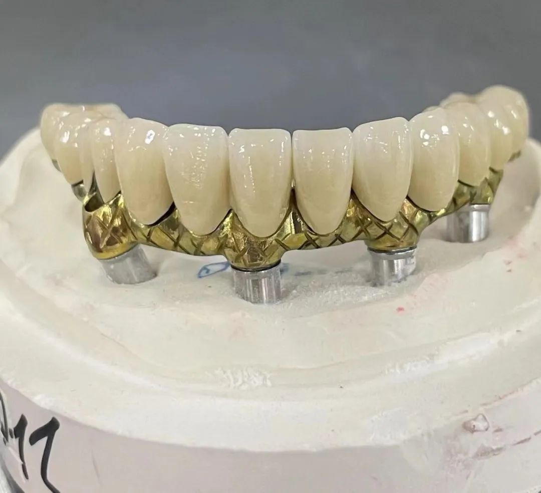 Sự khác biệt giữa thanh implant và cầu Malong