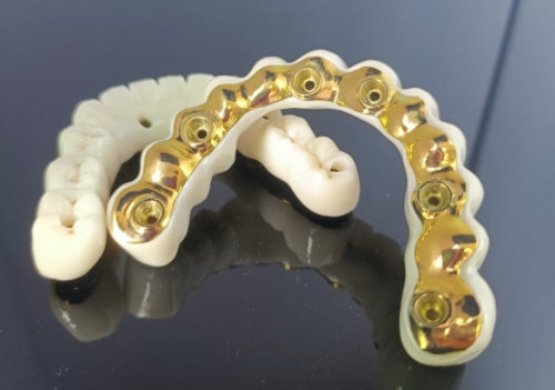Thanh cấy ghép Titan CAD/CAM+Cầu Zirconia