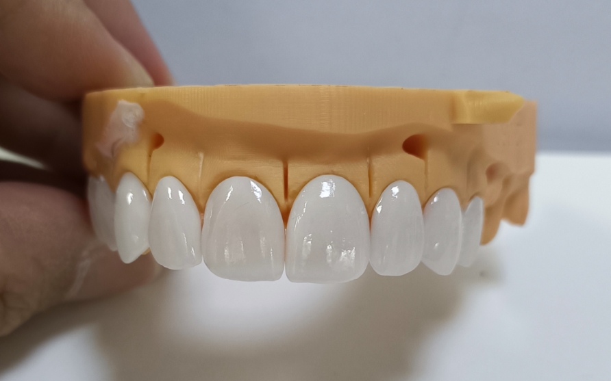 Veneer Emax có tính thẩm mỹ cao
