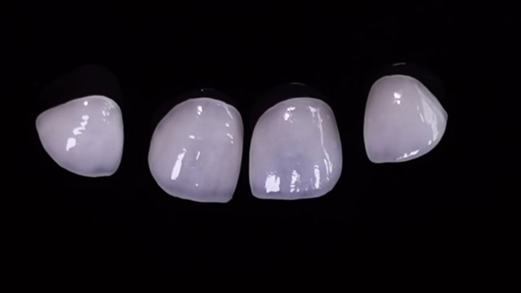 Veneers nha khoa