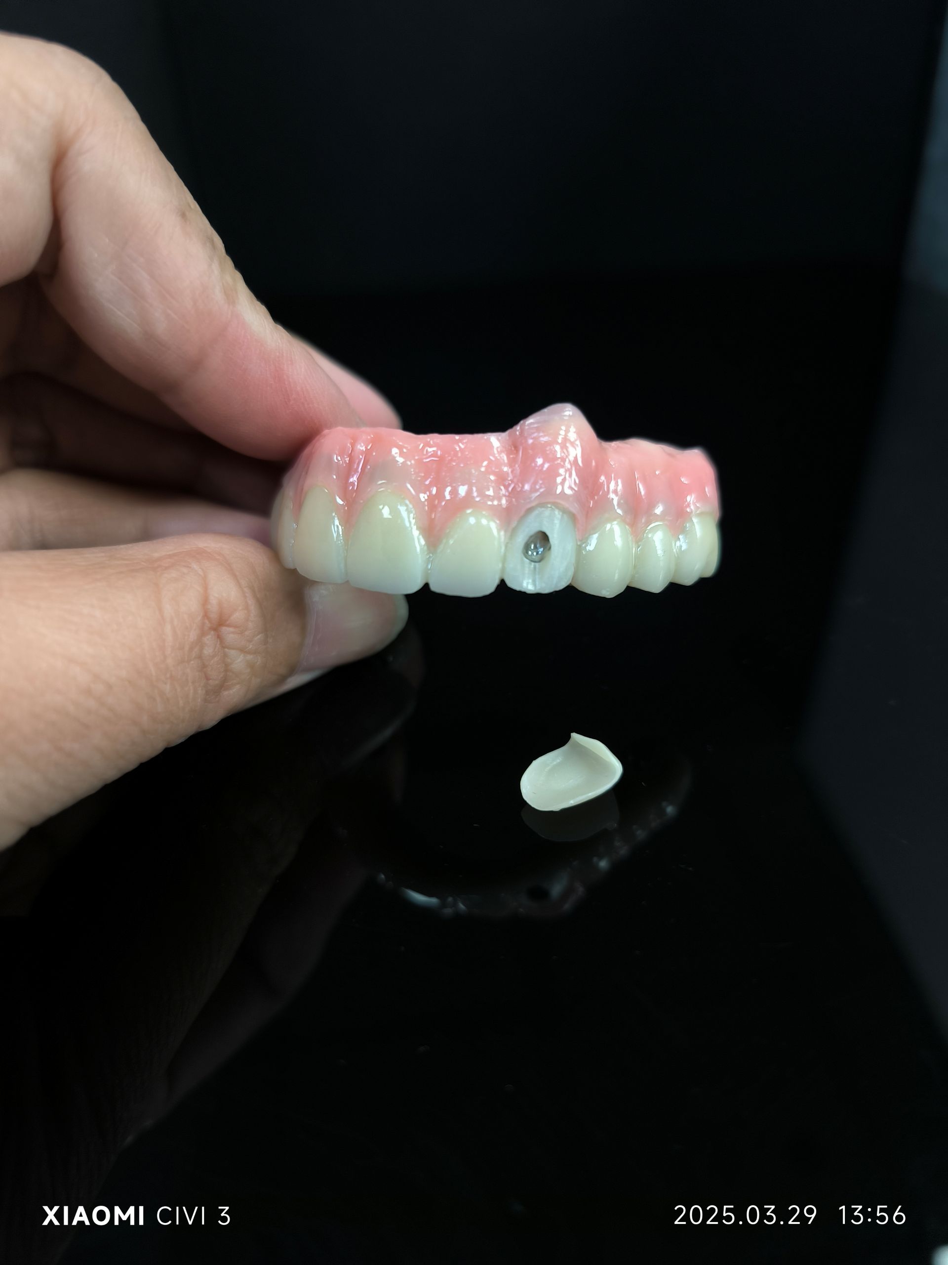 Tất cả trên 4 giải pháp cầu nối Zirconia lai cho lỗ vít tiền đình