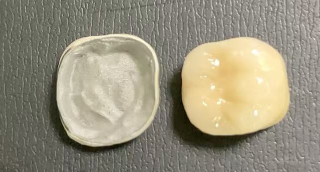 Những điều kiện nào được yêu cầu để có được vương miện bằng sứ cho đến kim loại?
