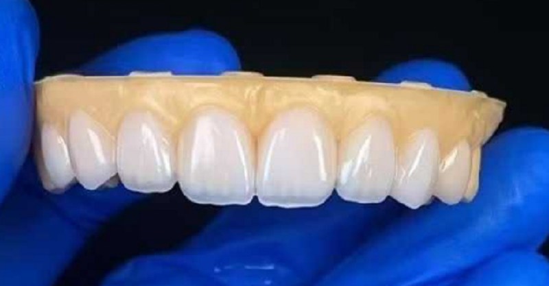 Veneers nha khoa để sửa chữa vấn đề khoảng cách răng quá mức