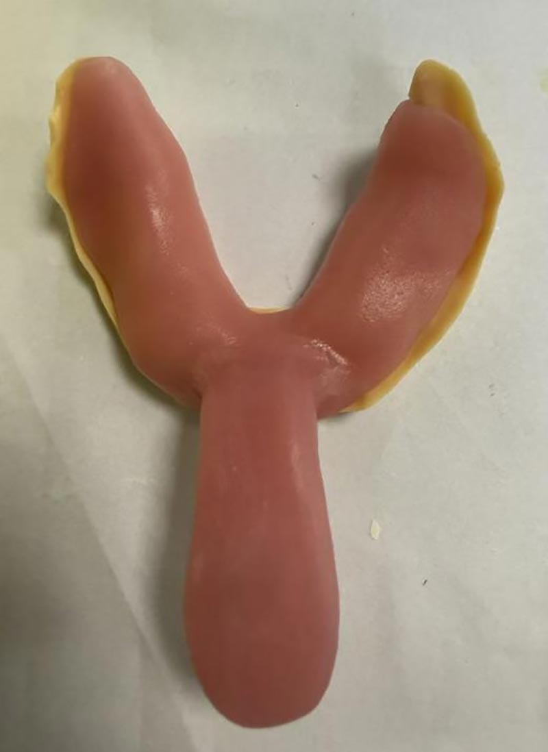 Những điều bạn chưa biết về khay nha khoa tùy chỉnh