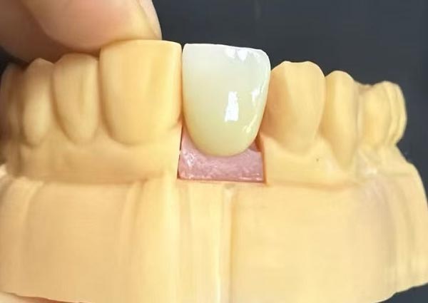 Khoảng cách giữa các răng có thể được khắc phục—Răng thẳng là hấp dẫn nhất!