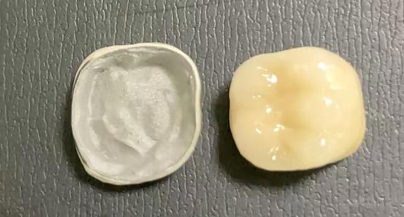 Phải làm gì khi mão răng sứ của bạn bị sứt mẻ? Đây là lý do tại sao nó xảy ra và cách khắc phục