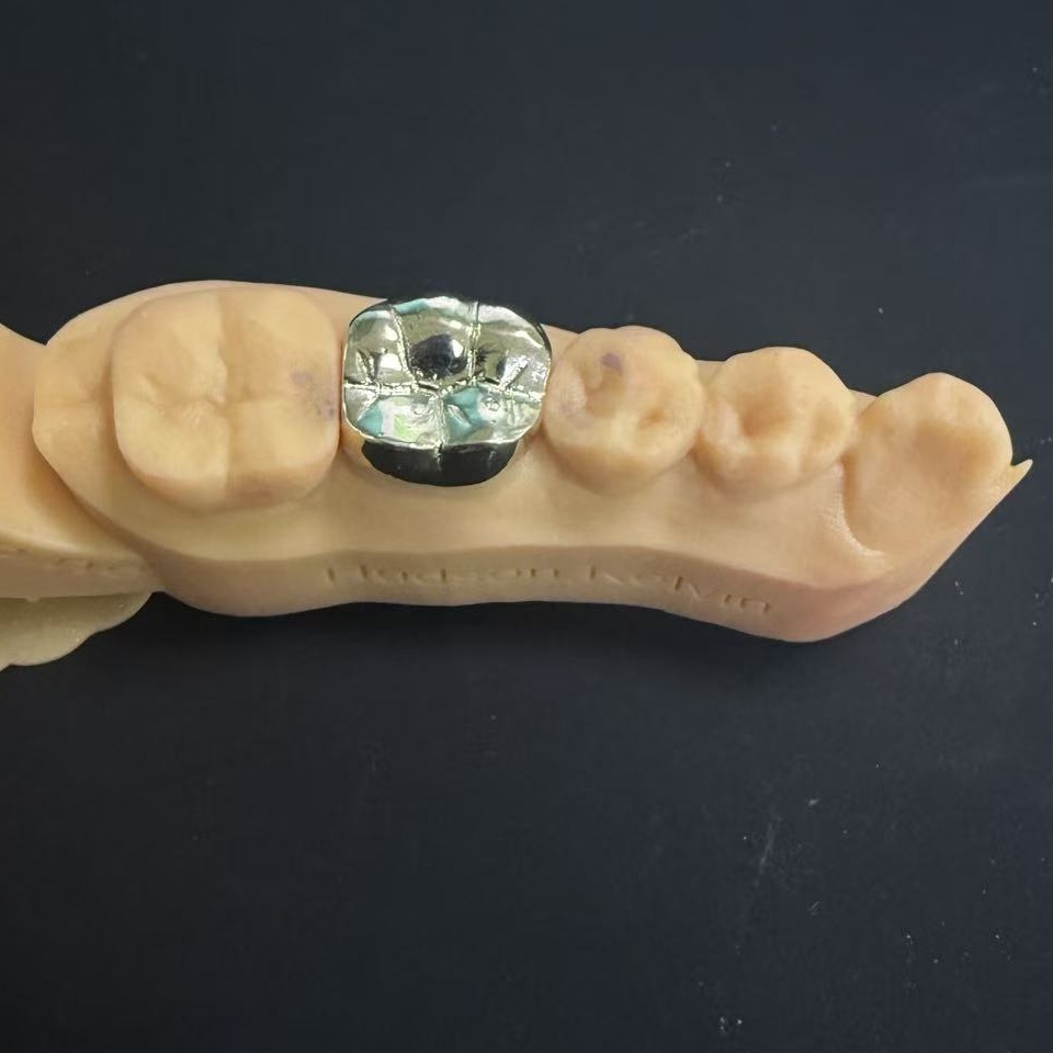 Mão răng vàng: Sự lựa chọn kim loại quý để phục hồi răng suốt đời