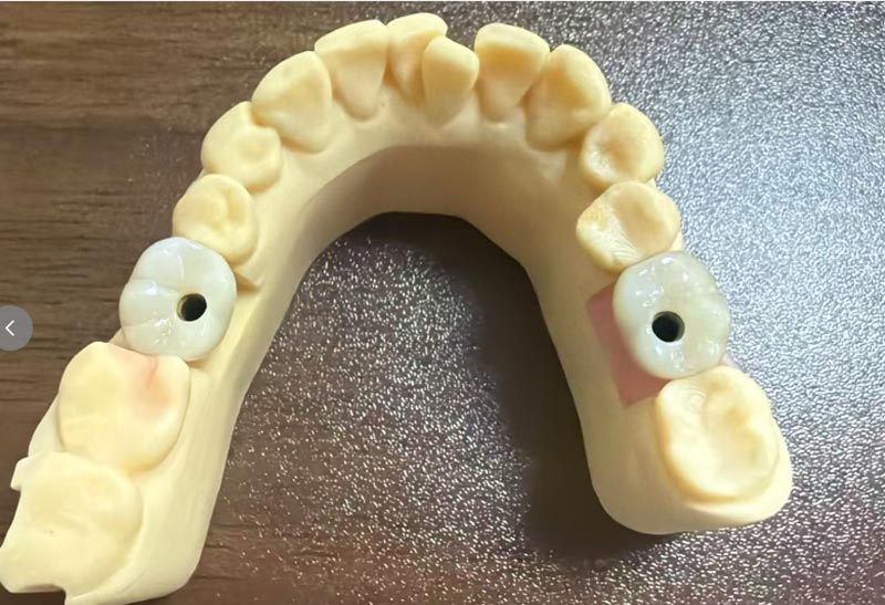 Tại sao cấy ghép răng cửa lại khó khăn hơn cấy ghép răng sau?