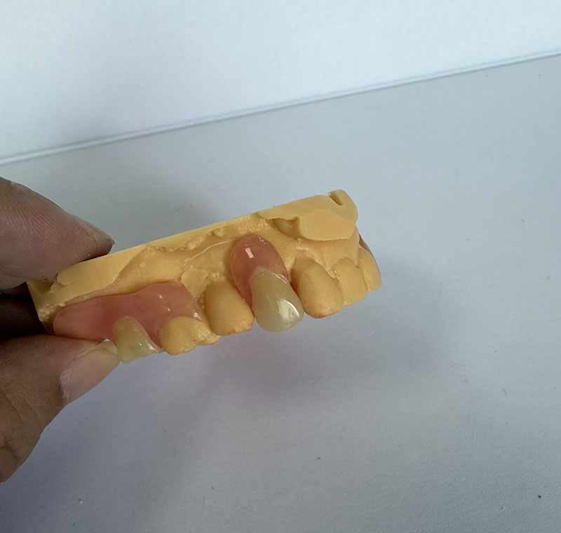Valplast Partials tại Phòng thí nghiệm Nha khoa WM