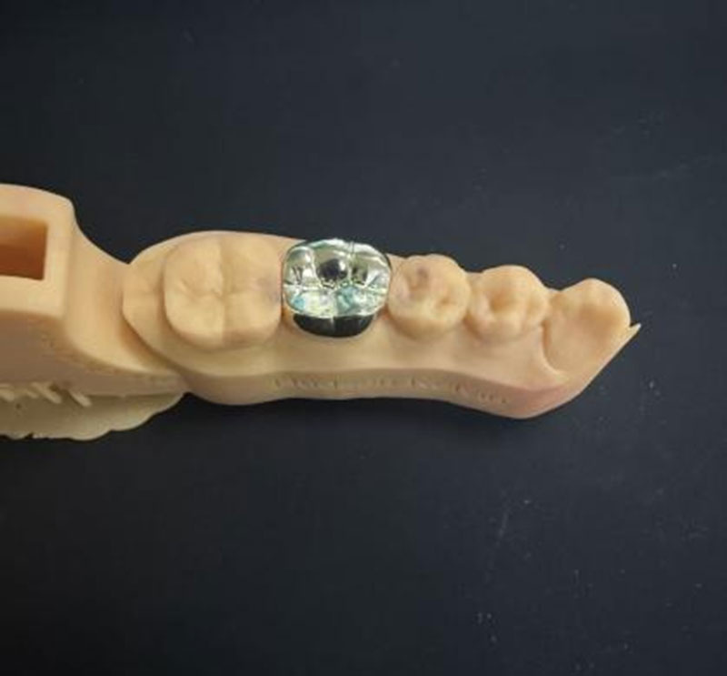 Răng Vàng VS Răng NPG