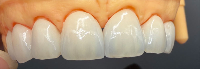 Tác động của răng không còn sống đối với mão toàn sứ và phương pháp điều trị tương ứng