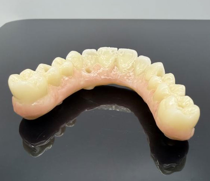 Vật liệu phổ biến cho mão răng và cầu răng