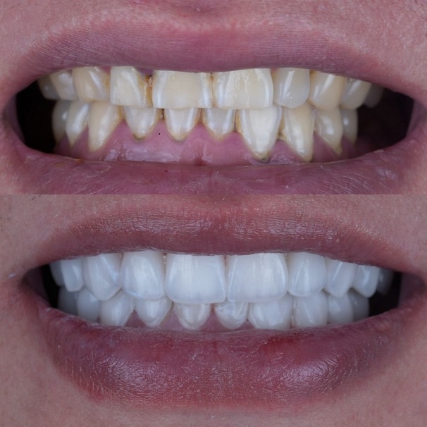 Emax Layered Veneers Phòng thí nghiệm nha khoa thẩm mỹ Trung Quốc