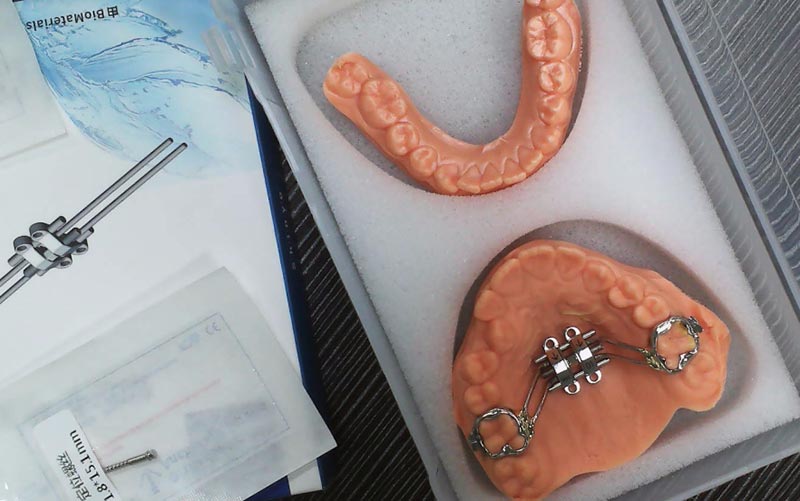 MSE (Maxillary Skeletal Expander)