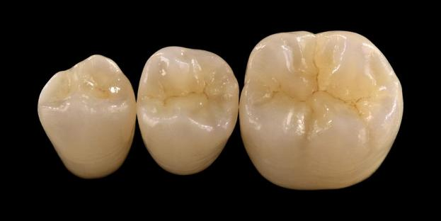 <h2>Zirconia trong Nha khoa: Chỉ định, Ưu điểm và Cân nhắc lâm sàng</h2>
<p>Zirconia được công nhận rộng rãi về sức mạnh và độ bền. Các thế hệ vật liệu zirconia mới nhất cũng mang lại đặc tính thẩm mỹ được cải thiện đáng kể. Đối với những bệnh nhân đang cân nhắc phục hình toàn sứ, điều cần thiết là phải đánh giá cẩn thận cả chỉ định và hạn chế của hệ thống dựa trên zirconia.</p>
<p>Bệnh nhân ngày nay ngày càng mong đợi sự phục hồi kết hợp tính thẩm mỹ tuyệt vời với hiệu quả chức năng đầy đủ. Hầu hết các hệ thống sứ hiện đại có thể đáp ứng những mong đợi này, nhưng thành công lâm sàng phần lớn phụ thuộc vào việc lựa chọn vật liệu, chuẩn bị răng và quy trình gắn xi măng phù hợp. Sự lựa chọn phải được hướng dẫn bởi các đặc tính vật liệu chính như khả năng chống gãy, độ bền uốn, khả năng chống mài mòn và độ ổn định lâu dài. Trong số các vật liệu này, zirconia đã trở thành một trong những lựa chọn được sử dụng rộng rãi nhất trong nha khoa phục hồi hiện đại.</p>
<h3>Tại sao chọn Zirconia?</h3>
<p>Zirconia được đánh giá cao nhờ độ bền vượt trội và độ bền lâu dài. Zirconia hiện đại khác biệt đáng kể so với các thế hệ trước, mờ đục hơn và kém thẩm mỹ hơn. Ngày nay, công nghệ CAD/CAM cho phép chế tạo chính xác các phục hình zirconia với các đặc tính quang học được cải thiện.</p>
<p>Phục hồi có thể được thiết kế như sau:</p>
<ul>
<li><strong>Zirconia nguyên khối:</strong>Lý tưởng cho mão và cầu răng sau, mang lại độ bền và độ bền cao.</li>
<li><strong>Zirconia phân lớp:</strong>Thích hợp cho những trường hợp cần nâng cao tính thẩm mỹ, bao gồm phục hồi lâu dài trên các vùng khác nhau của miệng.</li>
</ul>
<p>Độ bền uốn thay đổi tùy theo loại, từ khoảng 590 MPa ở zirconia có độ trong cao đến lên tới 1400 MPa ở dạng nguyên khối. Phục hồi Zirconia có thể được gắn bằng xi măng nhựa tự dính hoặc xi măng ionomer thủy tinh biến tính bằng nhựa.</p>
<h3>Các yếu tố chính trong việc lựa chọn vật liệu Zirconia</h3>
<p>Khi xem xét sử dụng zirconia cho phục hình toàn sứ, bác sĩ lâm sàng nên đánh giá một số yếu tố quan trọng:</p>
<ul>
<li>Cấu trúc răng còn lại</li>
<li>Vị trí trong khoang miệng (vùng thẩm mỹ và vùng chức năng)</li>
<li>Sự hiện diện của các thói quen cận chức năng như nghiến răng</li>
<li>Độ trong mờ của răng tự nhiên liền kề</li>
<li>Màu sắc và tình trạng cấu trúc răng bên dưới</li>
</ul>
<p>Vùng thẩm mỹ thường bao gồm các răng trước, mặc dù ở một số bệnh nhân, nó có thể kéo dài đến răng hàm thứ nhất tùy thuộc vào đường cười và chuyển động của khuôn mặt. Vùng chức năng thường bao gồm răng tiền hàm và răng hàm, nơi lực nhai cao hơn đáng kể.</p>
<h3>Ứng dụng vùng chức năng</h3>
<p>Ở các vùng phía sau, lực nhai phải được xem xét cẩn thận. Zirconia là một sự thay thế tuyệt vời cho phục hình PFM truyền thống, đặc biệt trong những trường hợp có không gian phục hồi hạn chế. Zirconia nguyên khối hiện đại cho phép thiết kế toàn diện giải phẫu khớp cắn, bao gồm các múi chức năng và các gờ rìa, trong khi vẫn duy trì độ bền cao.</p>
<p>Bằng chứng hiện tại cho thấy zirconia nguyên khối rất phù hợp cho mão răng sau và cầu răng nhiều đơn vị do khả năng chống gãy và mài mòn tuyệt vời của nó. Những tiến bộ trong kỹ thuật kết dính và thiết kế bào chế cũng đã cải thiện kết quả lâm sàng lâu dài.</p>
<h3>Ứng dụng vùng thẩm mỹ</h3>
<p>Ở vùng răng trước, phục hình phải tái tạo gần giống màu sắc tự nhiên, độ trong suốt và đặc tính ánh sáng của răng. Mặc dù các vật liệu như lithium disilicate mang lại tính thẩm mỹ tuyệt vời nhưng chúng lại kém bền hơn và thường yêu cầu liên kết bằng chất kết dính.</p>
<p>Ưu điểm chính của zirconia là khả năng được gắn xi măng thông thường mà vẫn đạt được hiệu quả thẩm mỹ cao. Với sự phát triển của hệ thống zirconia có độ trong suốt cao và đa lớp, giờ đây có thể tạo ra những phục hình gần giống với răng tự nhiên.</p>
<p>Các kỹ thuật xử lý tiên tiến giúp nâng cao hơn nữa các đặc tính quang học và giảm thiểu các khuyết điểm có thể ảnh hưởng đến sự truyền ánh sáng và hình thức.</p>
<h3>Sức mạnh và tính thẩm mỹ kết hợp</h3>
<p>Các hệ thống zirconia ban đầu ưu tiên độ bền nhưng thiếu chất lượng thẩm mỹ. Zirconia nguyên khối hiện đại kết hợp thành công cả sức mạnh và vẻ ngoài được cải thiện, khiến nó phù hợp với nhiều trường hợp lâm sàng.</p>
<p>Nó đặc biệt có lợi cho những bệnh nhân có thói quen cận chức năng hoặc thất bại trong phục hồi trước đó. Các nghiên cứu lâm sàng cho thấy sự chấp nhận của bệnh nhân cao và tỷ lệ biến chứng thấp.</p>
<p>Những lo ngại về tình trạng mòn răng đối diện đã được giảm bớt với các công thức mới hơn. Bề mặt zirconia có độ bóng cao thể hiện khả năng mài mòn thấp và trong một số trường hợp có thể nhẹ nhàng hơn so với phục hồi bằng sứ kết hợp với kim loại truyền thống.</p>
<h3>Cấy ghép Zirconia: Giải pháp thay thế mới nổi</h3>
<p>Trong khi cấy ghép titan vẫn là tiêu chuẩn lâm sàng, cấy ghép zirconia đang được chú ý như một giải pháp thay thế không chứa kim loại. Các thiết kế ban đầu chủ yếu là hệ thống một mảnh, nhưng cấy ghép zirconia hai mảnh hiện nay cho phép cải thiện tính linh hoạt của bộ phận giả.</p>
<p>Cấy ghép Zirconia đặc biệt hữu ích trong những trường hợp tồn tại những lo ngại về mặt thẩm mỹ, chẳng hạn như khả năng đổi màu xám của các mô quanh implant hoặc kiểu sinh học nướu mỏng. Chúng cũng có thể được xem xét cho những bệnh nhân hiếm gặp nhạy cảm với titan.</p>
<p>Tuy nhiên, cấy ghép zirconia vẫn còn tương đối mới và dữ liệu lâm sàng dài hạn vẫn còn hạn chế so với hệ thống titan.</p>
<h3>Phần kết luận</h3>
<p>Zirconia đã phát triển thành một vật liệu rất linh hoạt trong nha khoa phục hồi, mang lại sự cân bằng mạnh mẽ giữa hiệu suất cơ học và tính thẩm mỹ. Lựa chọn trường hợp thích hợp và tuân thủ các phác đồ lâm sàng là điều cần thiết để đạt được kết quả tối ưu ở cả ứng dụng trước và sau.</p>