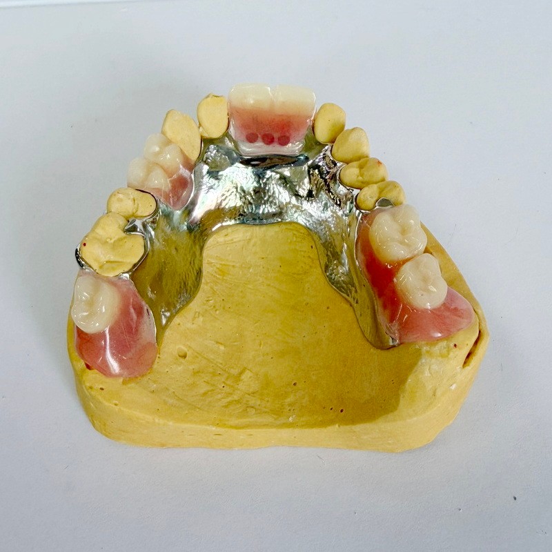 Khung một phần phục hồi có thể tháo rời